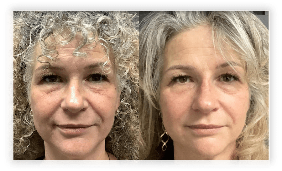 Before and after photos of a woman undergoing a jowl lift using PLLA/PLGA thread lifts, showcasing significant jawline enhancement
