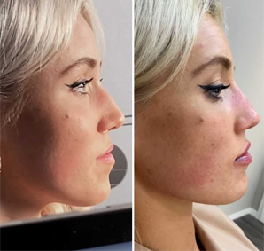 Cheek Filler Jaw Contouring Before After Non Surgical Facial Sculpting 2