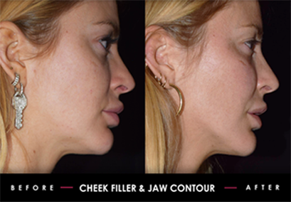 Cheek Filler Jaw Contouring Before After Non Surgical Facial Sculpting
