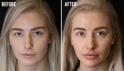 Facial Symmetry Before and After Fillers