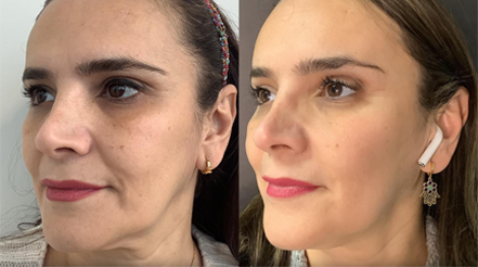 No Dimple Thread Lift Before After Woman Thread Lift Doctor 2