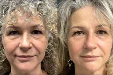 No Dimple Thread Lift Before After Woman Thread Lift Doctor