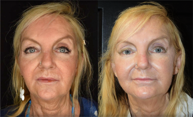 No Dimple Thread Lift Mississauga Oakville Before and After