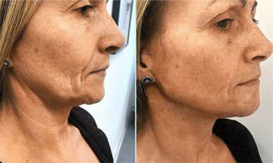 No Dimple Thread Lift