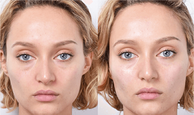non surgical facelift results before after mississauga oakville toronto