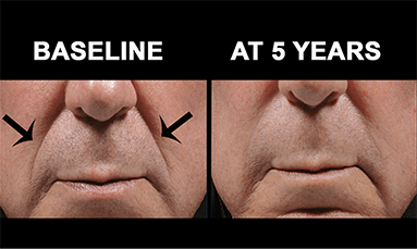 bellafill before after volume restoration mississauga oakville
