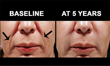 bellafill non surgical facial rejuvenation before aftere