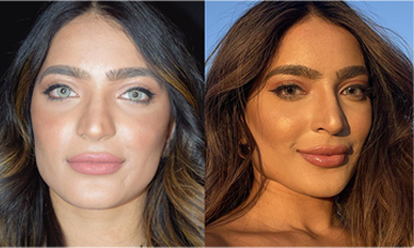 cheek enhancement dermal fillers before after mississauga oakville
