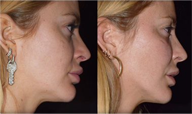 cheek filler jaw contouring mississauga oakville toronto