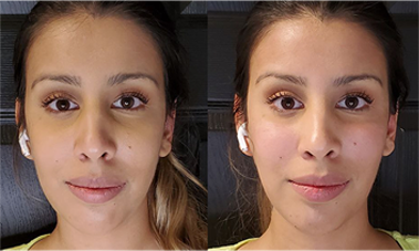 face filler results before after mississauga oakville