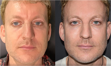 jawline thread lift results before after mississauga oakville