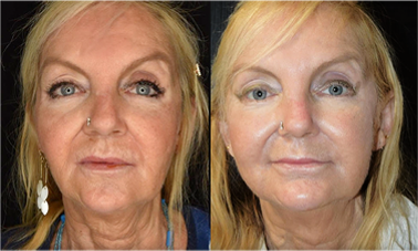 mid face thread lift results before after mississauga oakville
