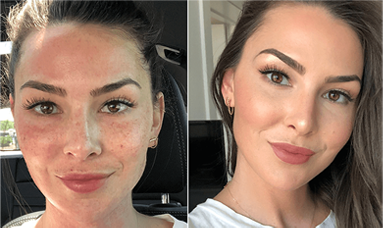 mid face thread lift results before after mississauga oakville