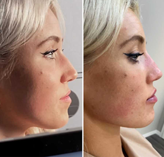 Cheek Filler Jaw Contouring Before After Non Surgical Facial Sculpting 2
