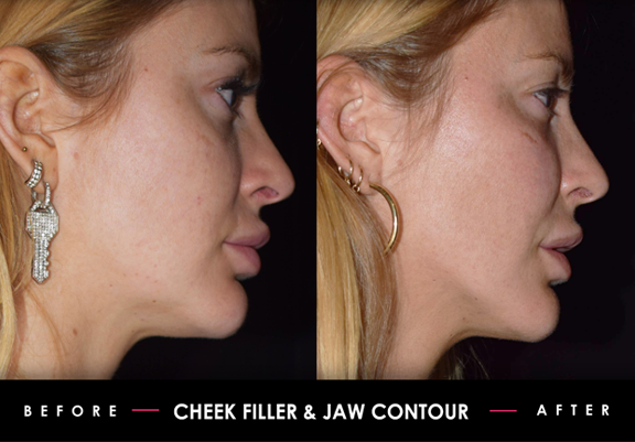 Cheek Filler Jaw Contouring Before After Non Surgical Facial Sculpting
