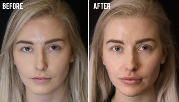 Facial Symmetry Before and After Fillers