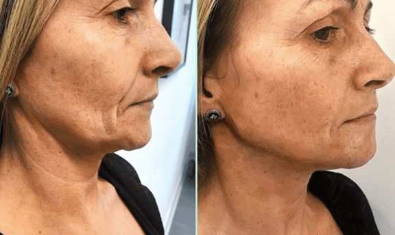 No Dimple Thread Lift