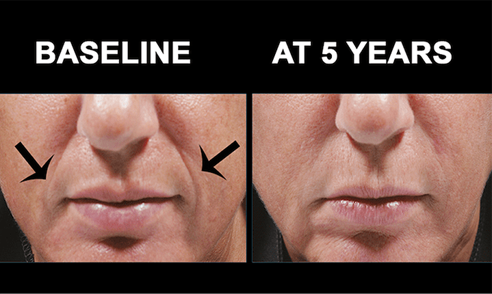 bellafill facial volumization results mississauga oakville