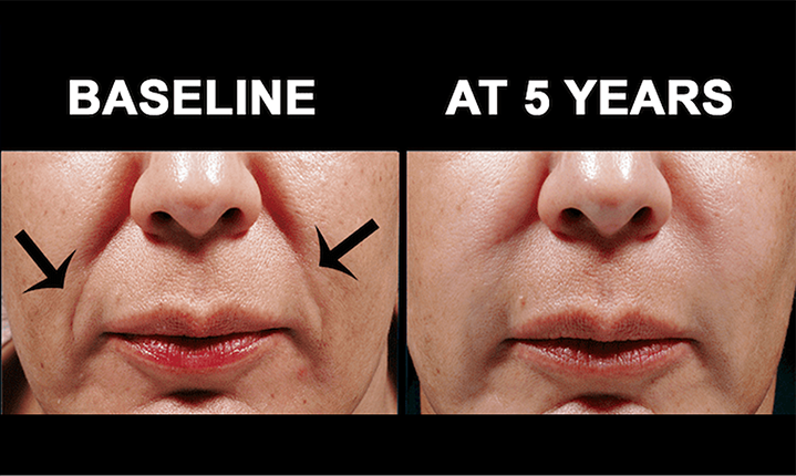 bellafill non surgical facial rejuvenation results