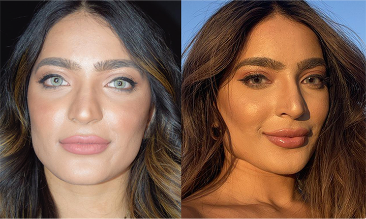 cheek enhancement dermal fillers results mississauga oakville