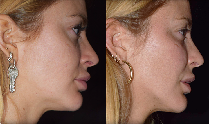 cheek filler jaw contouring mississauga oakville toronto