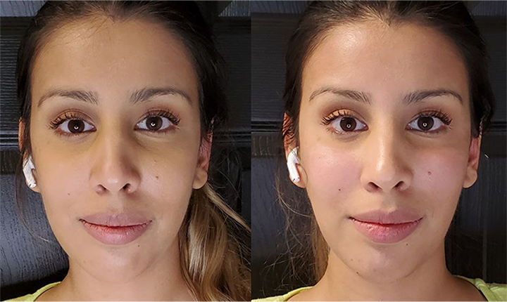 face filler results mississauga oakvilleo