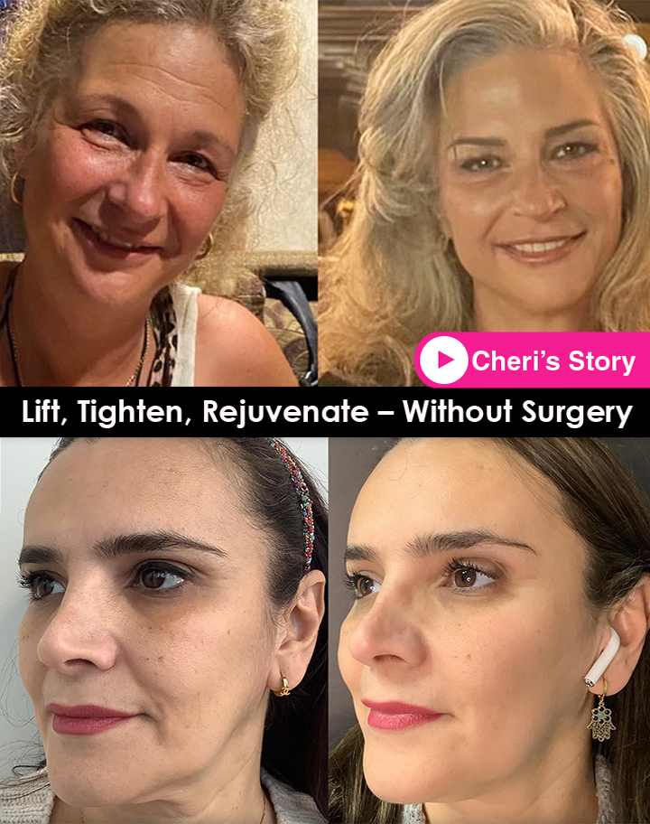 lift tighten rejuvenate with threads before after mississauga oakville toronto