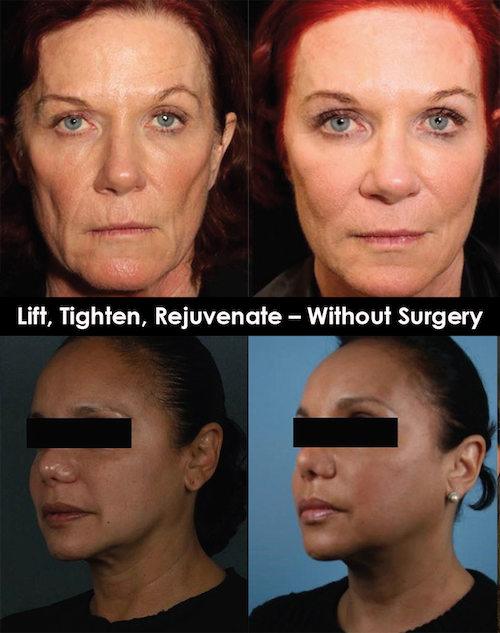 lift tighten rejuvenate without surgery before after mississauga oakville toronto