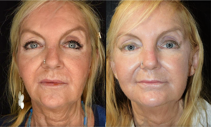 mid face thread lift results mississauga oakville