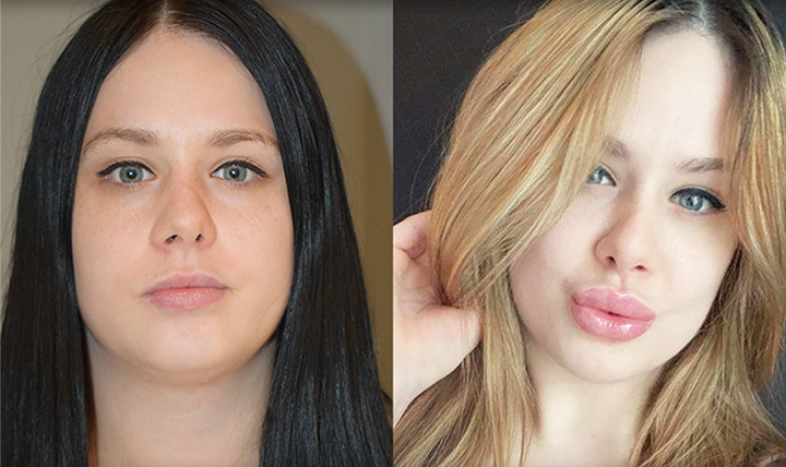 natural lip filler enhancement results mississauga thread lift doctor