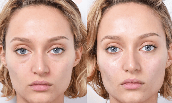 plasma facial rejuvenation before after mississauga oakville