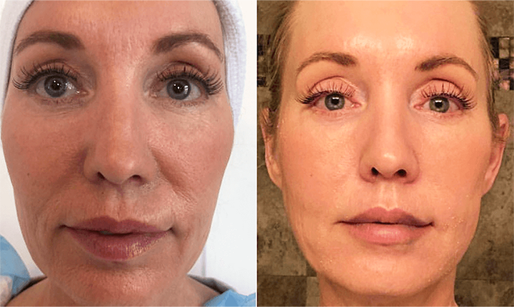 plasma facial rejuvenation results mississauga oakville