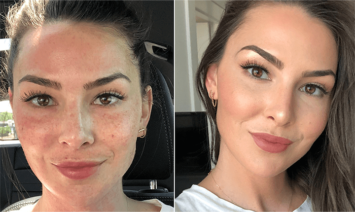 plasma facial skin rejuvenation before after mississauga oakville