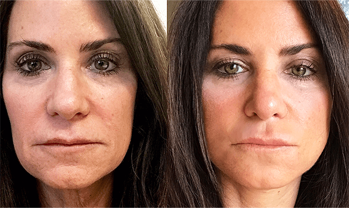 plasma facial skin revitalization results mississauga oakville