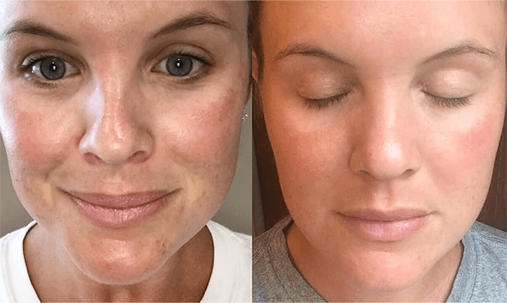 skin rejuvenation plasma facial before after mississauga oakville