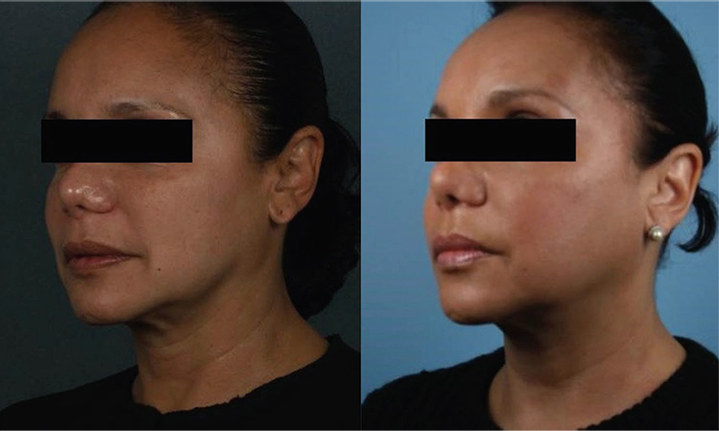 thread lift results mississauga oakville toronto