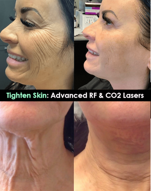 tighten skin advanced rf co2 lasers before after mississauga oakville toronto
