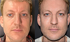 Jawline Thread Lift Before After Mississauga Oakville thumbnail