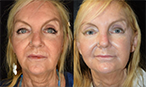 Mid Face Thread Lift Before After Mississauga Oakville thumbnail