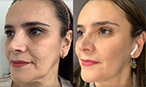 Thread Lift Face Lift Before After Mississauga Oakville thumbnail