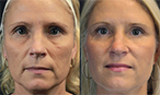 Thread Lift non surgical facelift before after mississauga oakville toronto thumbnail