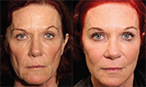 non surgical facelift before after mississauga oakville toronto thumbnail