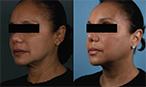 thread lift before after mississauga oakville toronto thumbnail