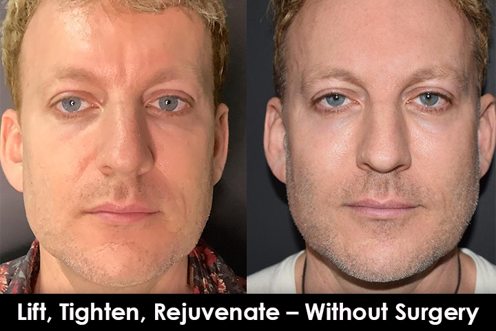 jawline thread lift before after mississauga oakville toronto