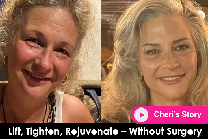 lift tighten rejuvenate threads before after mississauga oakville toronto