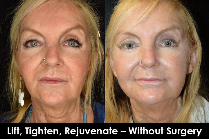 mid face thread lift before after mississauga oakville toronto