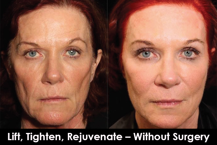 non surgical facelift before after mississauga oakville toronto