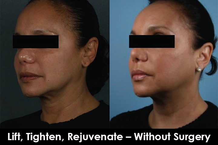 thread lift before after mississauga oakville toronto