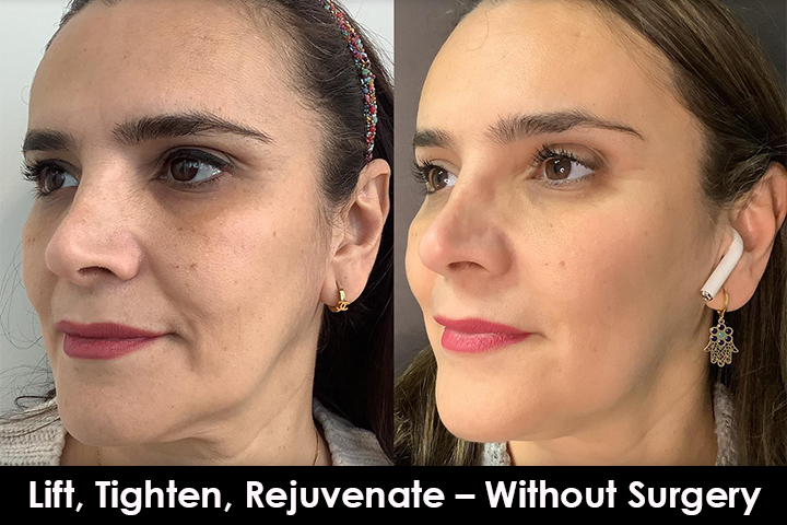 thread lift face lift before after mississauga oakville toronto