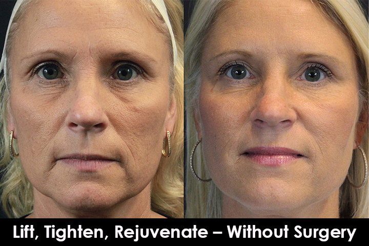 thread lift non surgical facelift before after mississauga oakville toronto